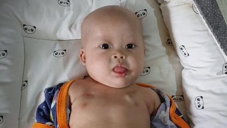 Kisah Chiara: Bayi 8 Bulan Berjuang Melawan Tumor Ganas dan Kelainan Bawaan