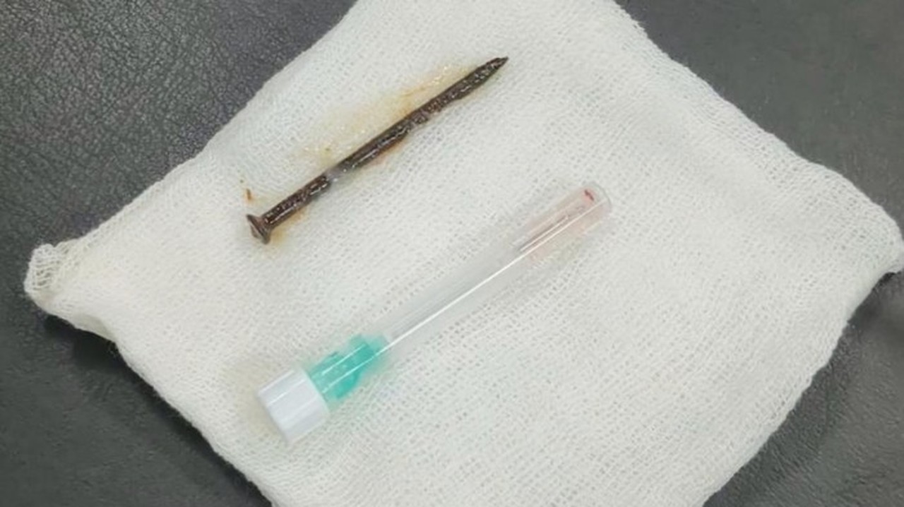 Pria 52 Tahun di Riau Tersedak Paku 5 Cm Saat Perbaiki Kamar, Nyangkut di Paru-paru