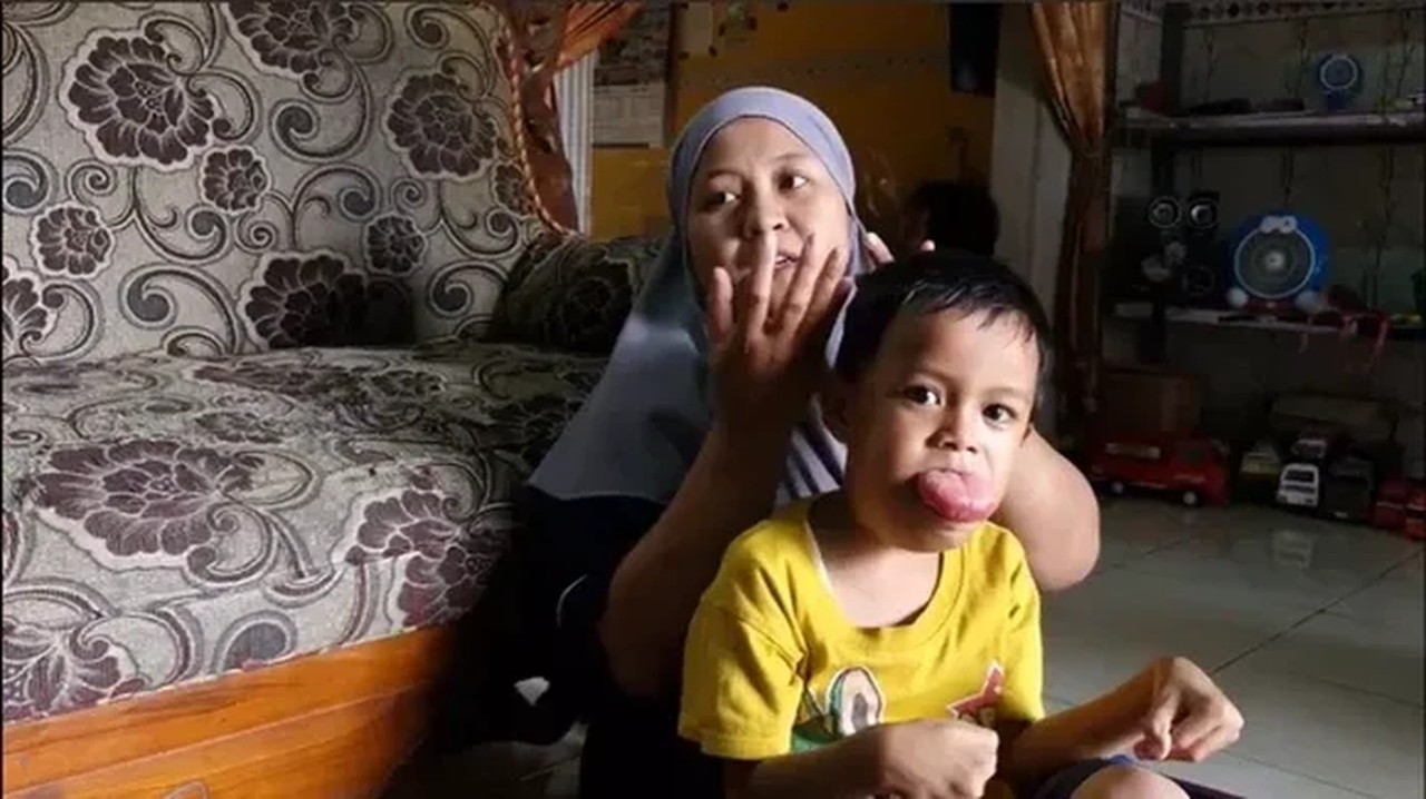 Kisah Febio, Bocah 6 Tahun Berjuang Melawan Tumor Lidah Sejak Lahir