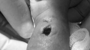 Tangan Bayi Bengkak dan Berlubang Pasca Infus, Orang Tua Polisikan RS di Makassar